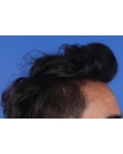 After Hair Transplant&nbsp;Front